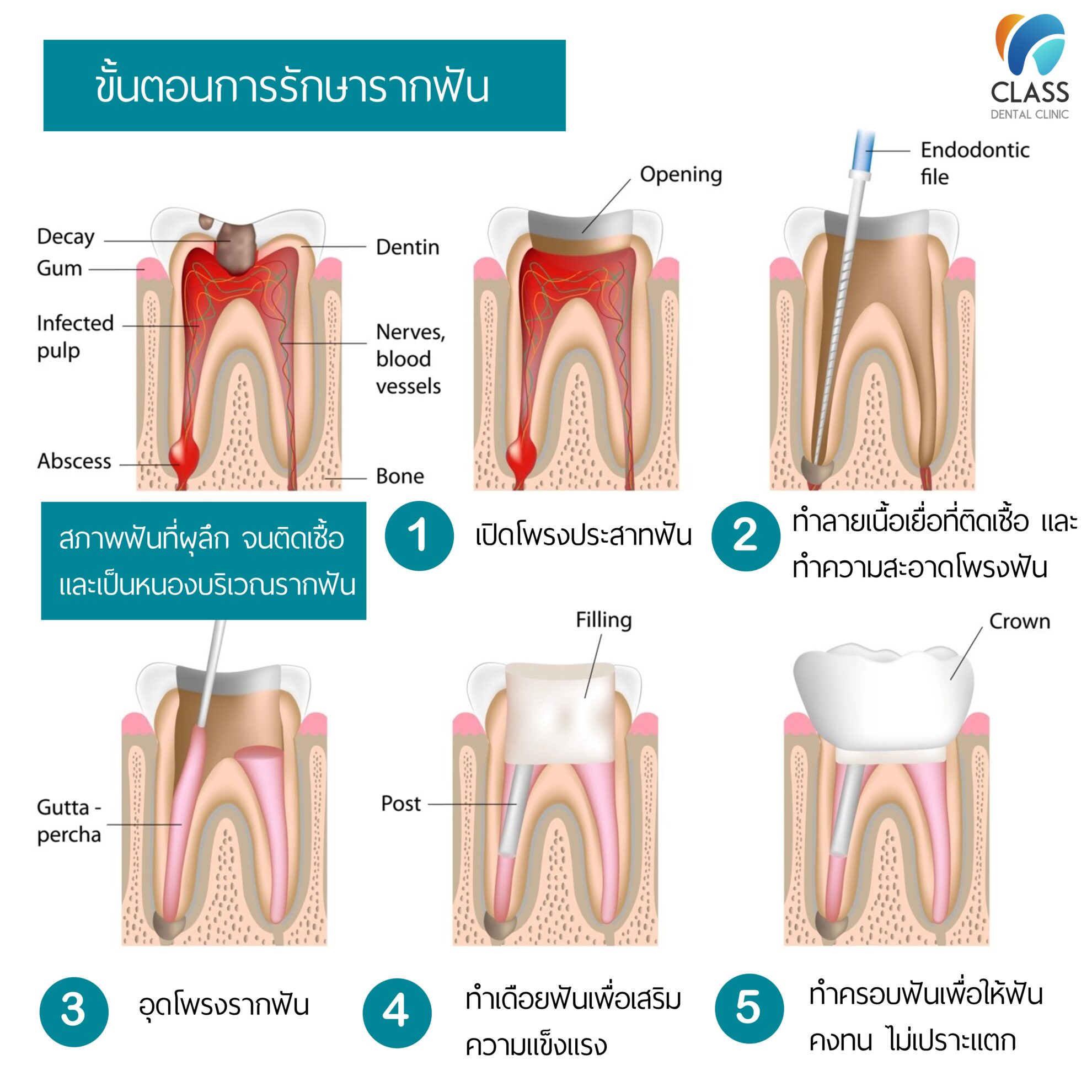 Second Stage Rct Root Canal Treatment (RCT) - CLASS Dental Clinic - คลินิกทันตกรรมคลาส